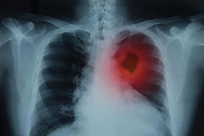 lung cancer xray